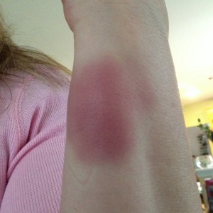 bruise 1